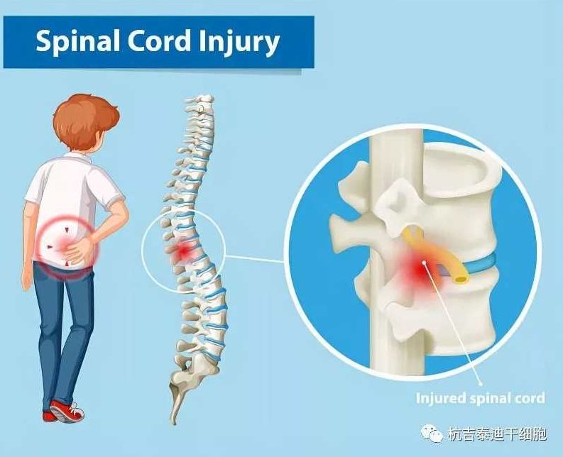 何立民 脊髓损伤并发症及其防治,脊柱骨折,脊髓损伤,第1张 何立民 脊髓损伤并发症及其防治,脊柱骨折,脊髓损伤,第1张