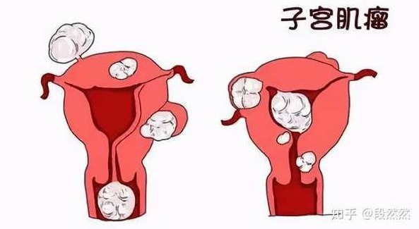 关铮 关于子宫肌瘤的几个热点问题,基础,理论,第1张