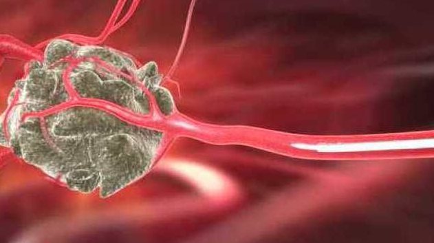 陈春林 子宫肿瘤的介入治疗,陈春林,子宫肿瘤,介入治疗,第1张