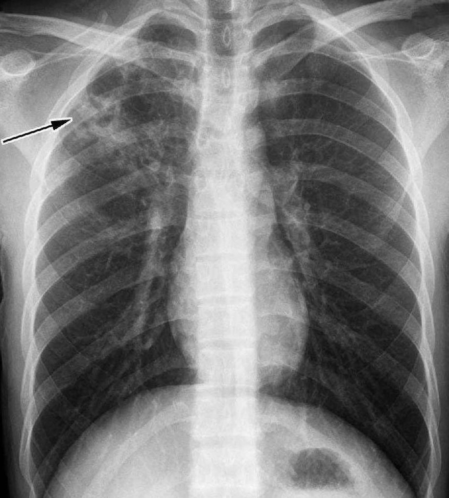 高微微 肺结核,研究,培训,教学,第1张