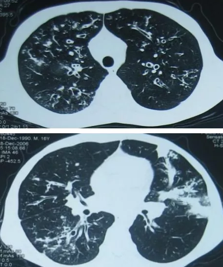 马艳良 支气管扩张,专家,研究,培训,第1张