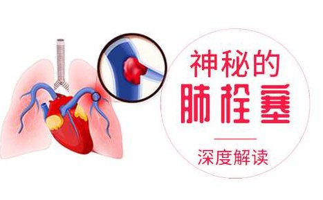 确诊肺栓塞 神秘的急性肺栓塞深度解读,课程,专家,基础,第1张 确诊肺栓塞 神秘的急性肺栓塞深度解读,课程,专家,基础,第1张